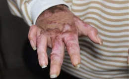 Kalfalık eğitimi sırasında meydana gelen kazada yüzde 80’i yanan lise öğrencisi 15 ameliyat geçirdi